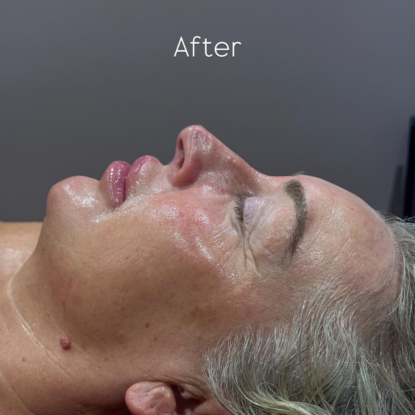 Before Image for The Deluxe Dermaplan